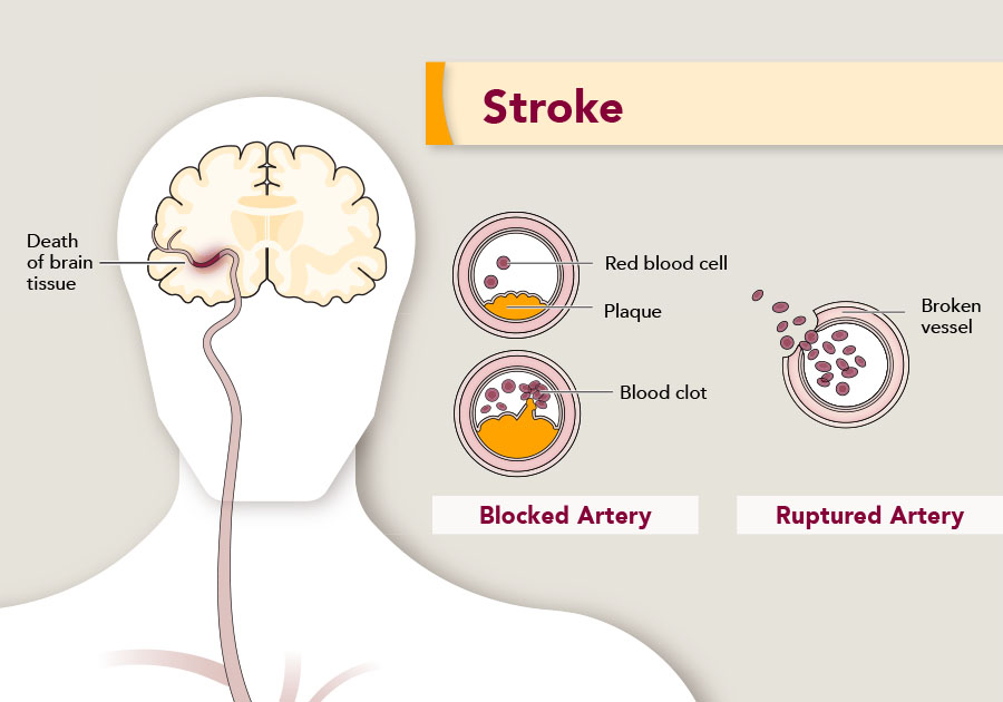 stroke causes infographic